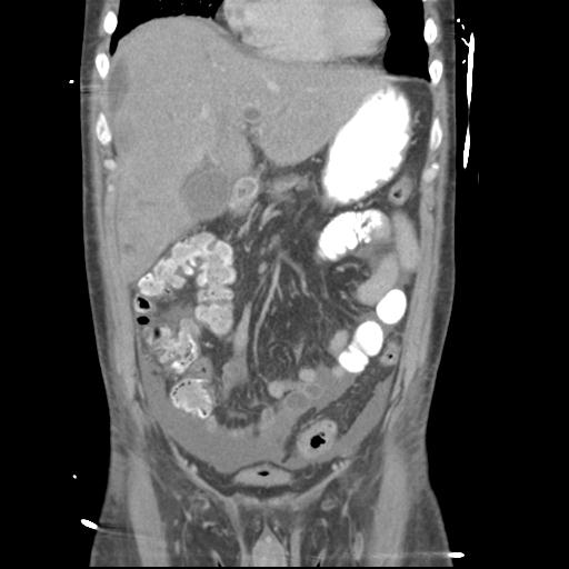 Chronic diverticulitis complicated by hepatic abscess and portal vein thrombosis (Radiopaedia 30301-30938 B 22).jpg