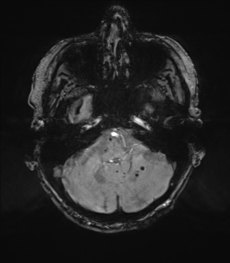 Chronic hypertensive encephalopathy (Radiopaedia 72844-83495 Axial SWI magnitude 17).png