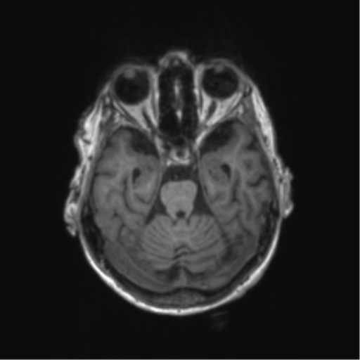 Chronic hypertensive encephalopathy (Radiopaedia 72844-83495 Axial T1 49).png