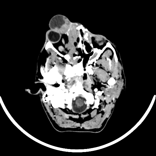 Chronic invasive fungal sinusitis with intraorbital and intracranial extension (Radiopaedia 56387-63046 B 70).jpg