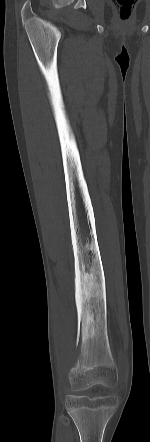 Chronic ostemyelitis of the femur with long sinus tract (Radiopaedia 74947-85982 Coronal bone window 42).jpg
