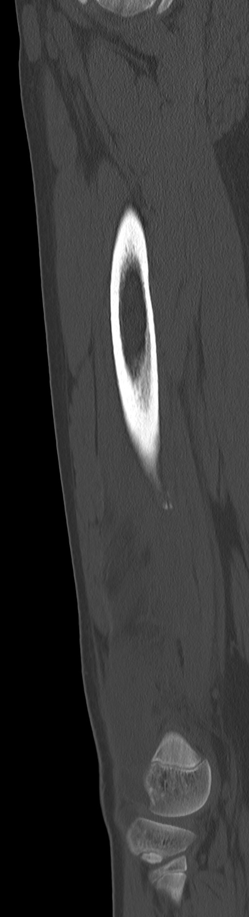 Chronic ostemyelitis of the femur with long sinus tract (Radiopaedia 74947-85982 Sagittal bone window 41).jpg