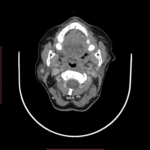 File:Chronic osteomyelitis - maxilla (Radiopaedia 23783-23927 B 53).jpg