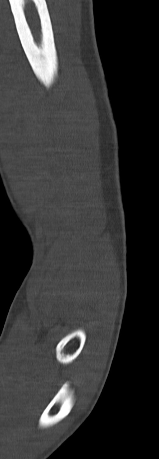 Chronic osteomyelitis of the distal humerus (Radiopaedia 78351-90971 Sagittal bone window 37).jpg
