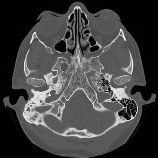 File:Chronic otomastoiditis (Radiopaedia 27138-27309 Axial bone window 16).jpg