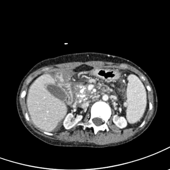 File:Chronic pancreatitis (Radiopaedia 55405-61846 A 38).jpg