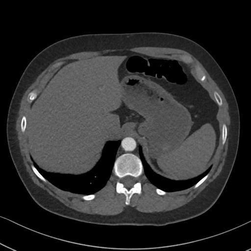 Chronic pulmonary embolus (Radiopaedia 39129-41341 Axial C+ CTPA 92).png