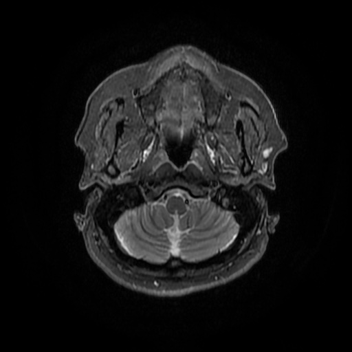 File:Chronic submandibular sialadenitis (Radiopaedia 61852-69885 Axial STIR 6).jpg