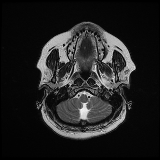 File:Chronic submandibular sialadenitis (Radiopaedia 61852-69885 Axial T2 5).jpg