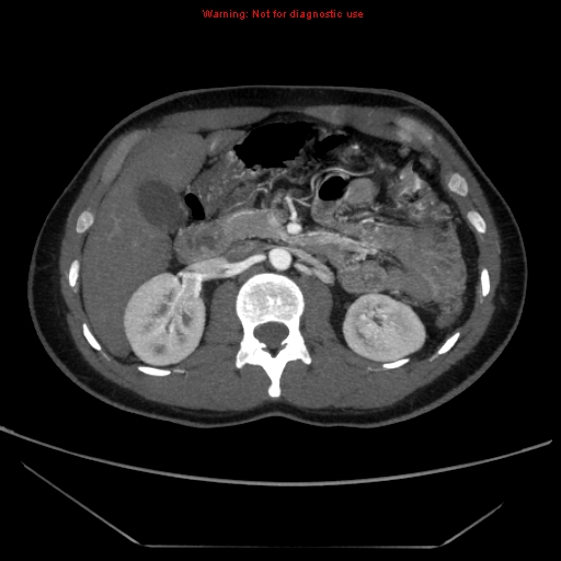File:Circumaortic left renal vein (Radiopaedia 9069-9792 A 19).jpg