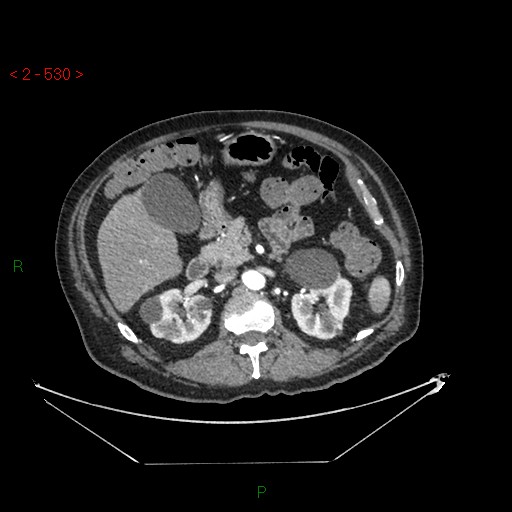 File:Circumaortic left renal vein and doubled left renal arteries (Radiopaedia 52268-58158 A 66).jpg