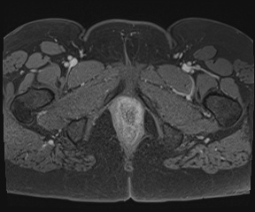 File:Class II Mullerian duct anomaly- unicornuate uterus with rudimentary horn and non-communicating cavity (Radiopaedia 39441-41755 Axial T1 fat sat 139).jpg