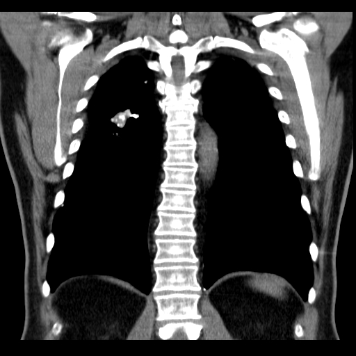 File:Classic complicated silicosis (Radiopaedia 49720-54961 Coronal liver window 47).jpg