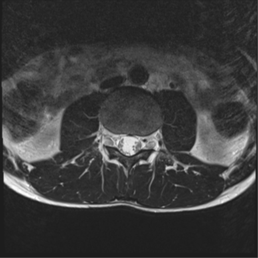 File:Clear cell meningoma - lumbar spine (Radiopaedia 60116-67690 Axial T2 28).png