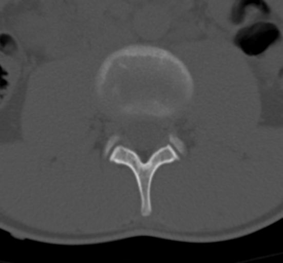 Clear cell meningoma - lumbar spine (Radiopaedia 60116-67691 Axial bone window 33).png