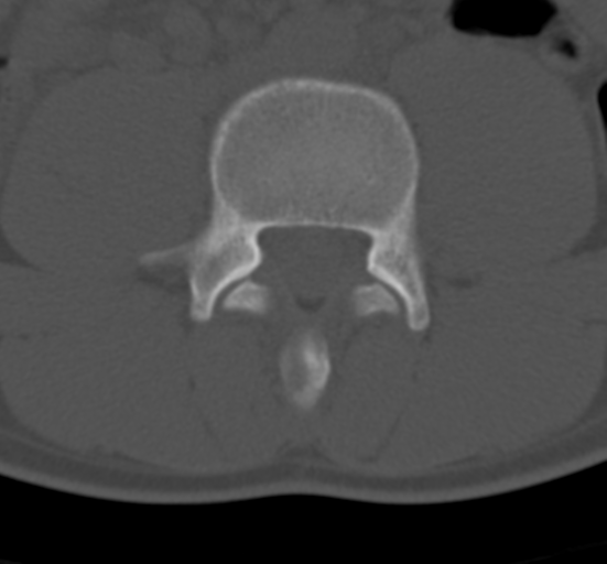 Clear cell meningoma - lumbar spine (Radiopaedia 60116-67691 Axial bone window 47).png