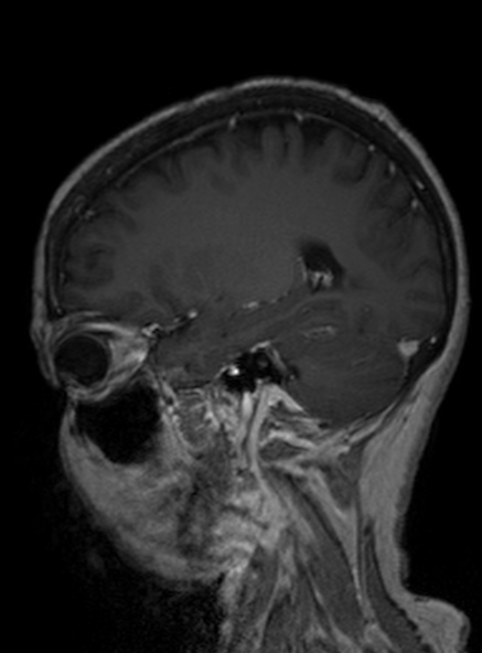 Clival meningioma (Radiopaedia 53278-59248 Sagittal T1 C+ 308).jpg