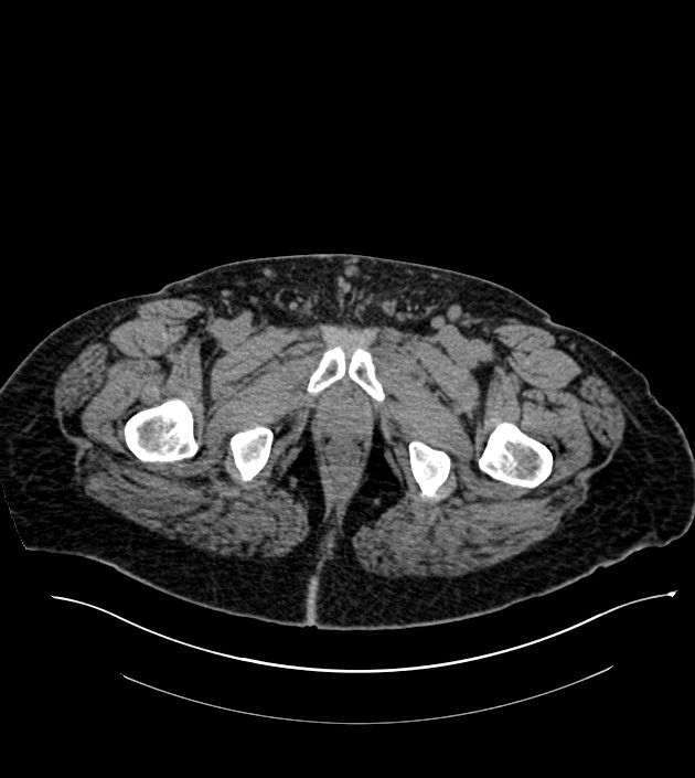 Closed-loop small bowel obstruction-internal hernia (Radiopaedia 78439-91096 Axial non-contrast 161).jpg