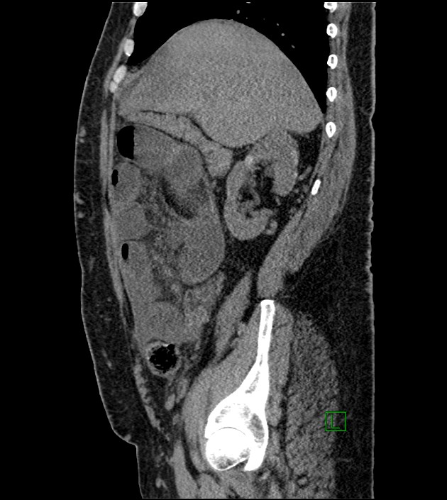 Closed-loop small bowel obstruction-internal hernia (Radiopaedia 78439-91096 C 102).jpg