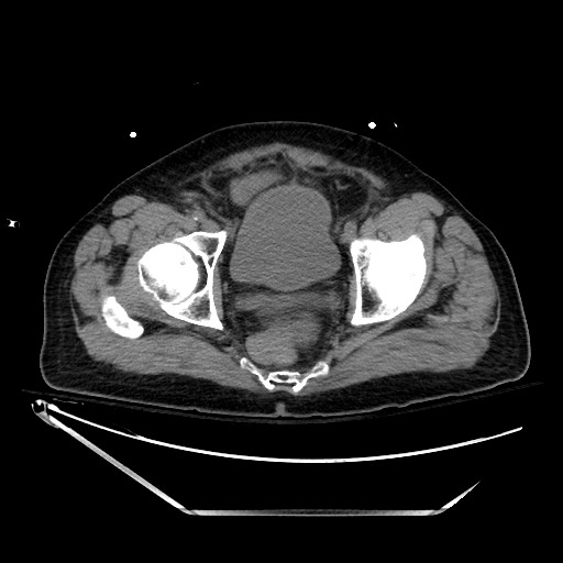 Closed loop obstruction due to adhesive band, resulting in small bowel ischemia and resection (Radiopaedia 83835-99023 Axial non-contrast 141).jpg
