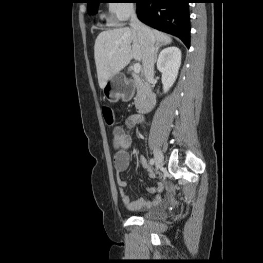 File:Closed loop small bowel obstruction (Radiopaedia 65403-74451 C 39).jpg