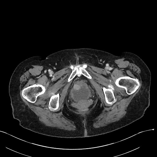File:Closed loop small bowel obstruction - adhesions (Radiopaedia 59269-66611 Axial 114).jpg