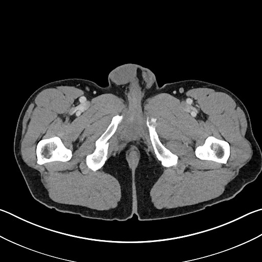File:Closed loop small bowel obstruction - internal hernia (Radiopaedia 57806-64778 B 141).jpg