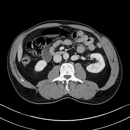 Closed loop small bowel obstruction - internal hernia (Radiopaedia 57806-64778 B 57).jpg