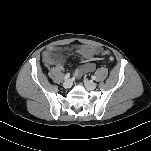 Closed loop small bowel obstruction - internal hernia (Radiopaedia 57806-64778 B 93).jpg
