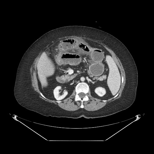 File:Closed loop small bowel obstruction - internal hernia (Radiopaedia 65402-74450 A 48).jpg