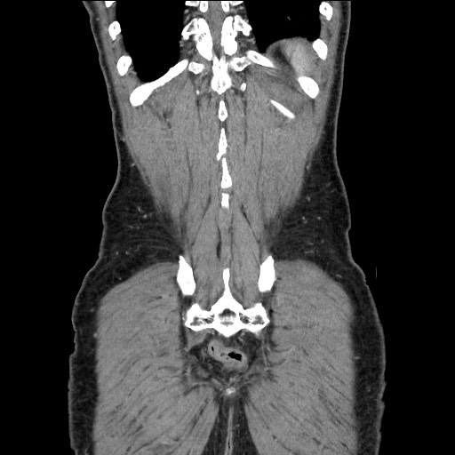 Closed loop small bowel obstruction - omental adhesion causing "internal hernia" (Radiopaedia 85129-100682 B 112).jpg