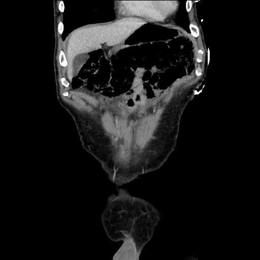 Closed loop small bowel obstruction - omental adhesion causing "internal hernia" (Radiopaedia 85129-100682 B 32).jpg