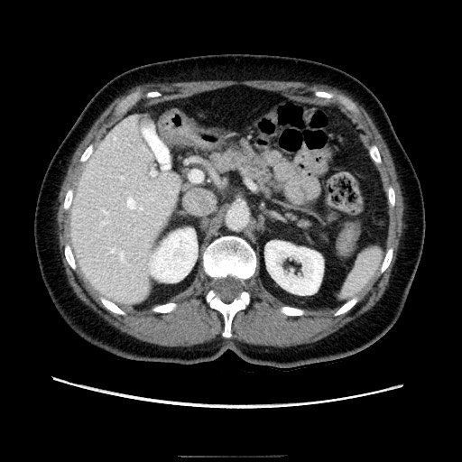 Closed loop small bowel obstruction due to adhesive bands - early and late images (Radiopaedia 83830-99015 A 46).jpg