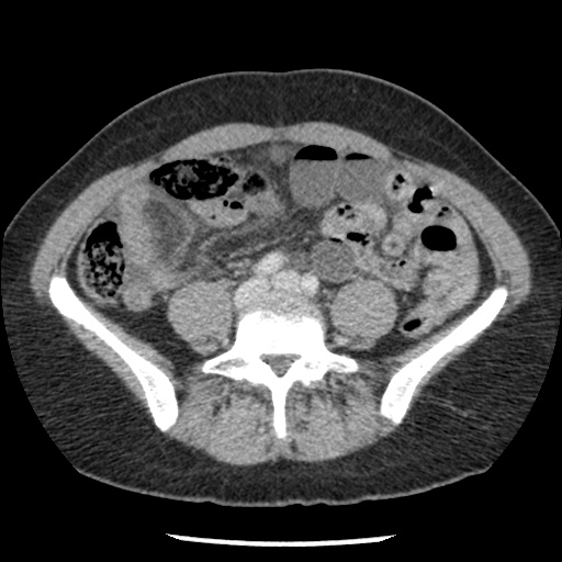 Closed loop small bowel obstruction due to trans-omental herniation (Radiopaedia 35593-37109 A 56).jpg