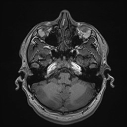 Cochlear incomplete partition type III associated with hypothalamic hamartoma (Radiopaedia 88756-105498 Axial T1 55).jpg