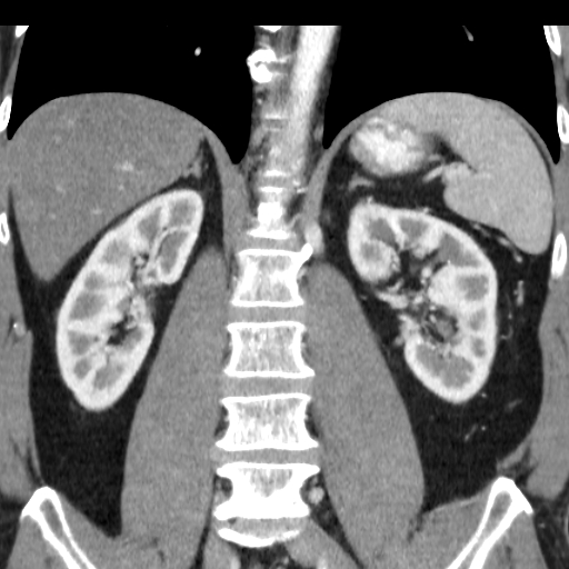 File:Collateral circulation following left renal vein thrombosis (Radiopaedia 17319-17013 renal cortical phase 9).jpg