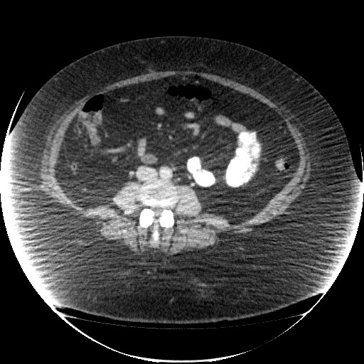 File:Collection due to leak after sleeve gastrectomy (Radiopaedia 55504-61972 A 47).jpg