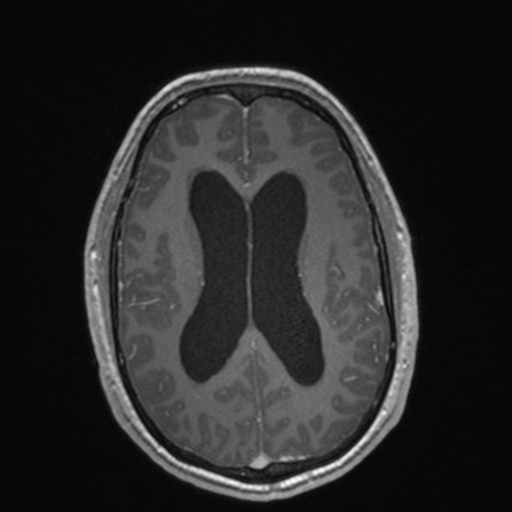 File:Colloid cyst (Radiopaedia 44510-48181 Axial T1 C+ 113).png