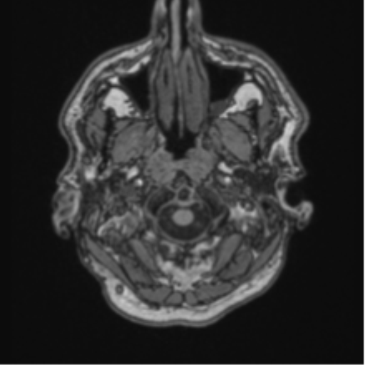 File:Colloid cyst of the third ventricle (Radiopaedia 86571-102662 Axial T1 8).png