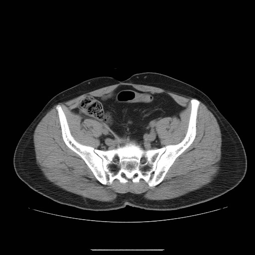 File:Colocutaneous fistula in Crohn's disease (Radiopaedia 29586-30093 Axial non-contrast 30).jpg