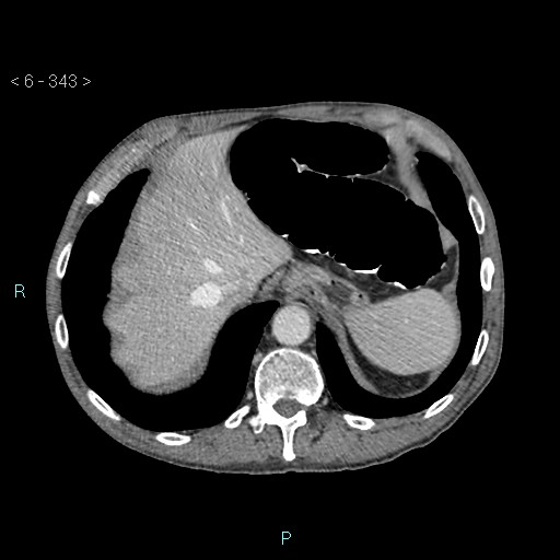 Colonic cancer (ultrasound and TC imaging) (Radiopaedia 50346-55713 B 343).jpg