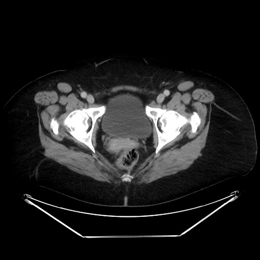 File:Colonic intussusception due to adenocarcinoma (Radiopaedia 86828-102987 A 141).jpg