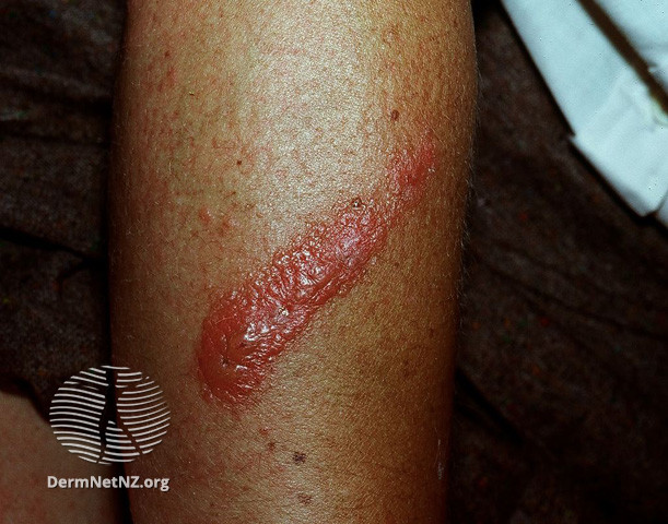 File:Contact allergic dermatitis (DermNet NZ dermatitis-acd-limbs-2459).jpg