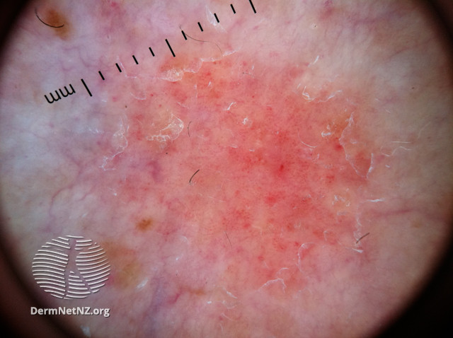 File:Dermoscopic view of psoriasis (DermNet NZ Psoriasis-dermoscopy).jpg