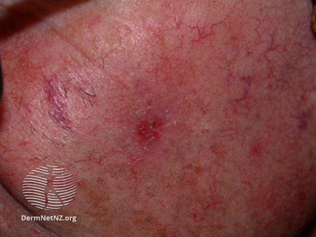 Intraepidermal carcinoma (DermNet NZ lesions-scc-in-situ-2939).jpg