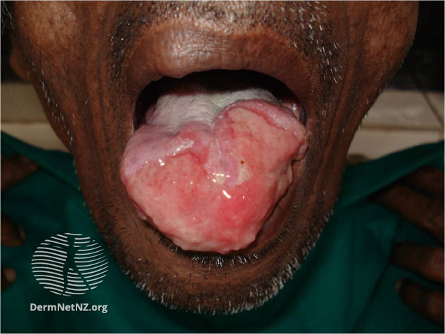 File:Mucosal leishmaniasis (DermNet NZ cutaneous-leishmaniasis-07-v3).jpg