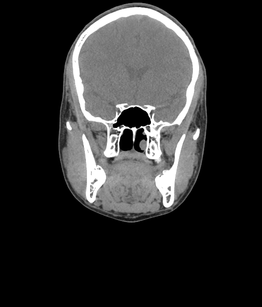 File:Nasal pyogenic granuloma (lobular capillary hemangioma) (Radiopaedia 85536-101244 Coronal non-contrast 97).jpg