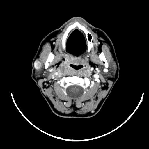 File:Nasopharyngeal carcinoma - infiltrating the clivus (Radiopaedia 62583-70875 Axial Post contrast 25).jpg