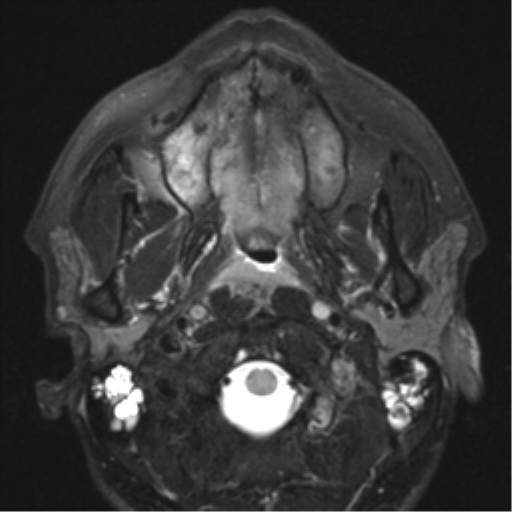 File:Nasopharyngeal carcinoma with pterygopalatine fossa involvement (Radiopaedia 33102-34134 Axial T2 14).png