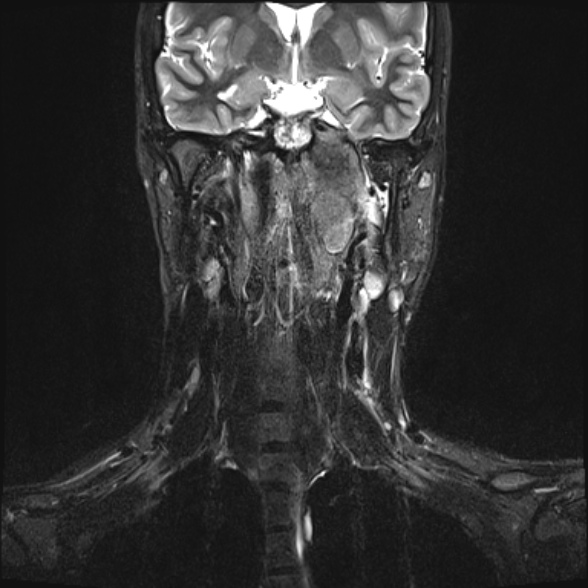 Nasopharyngeal carcinoma with skull base invasion (Radiopaedia 53415-59485 Coronal T2 fat sat 17).jpg